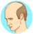 Alopecia Disease