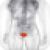 Bladder Cancer